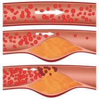 Cholesterol - wróg czy przyjaciel ?